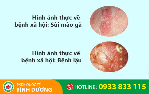 Hình ảnh bệnh sùi mào gà, bệnh lậu