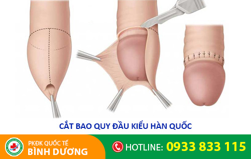Trị nấm dương vật bằng phương pháp cắt bao quy đầu kiểu Hàn Quốc