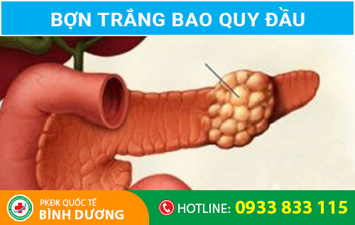 Hình ảnh bợn trắng bao quy đầu