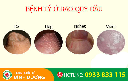 Tình trạng bất thường cảnh báo bệnh lý ở bao quy đầu