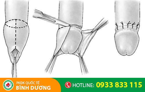 Cắt bao quy đầu bằng kỹ thuật hiện đại được xem là phương pháp tiên tiến hiện nay