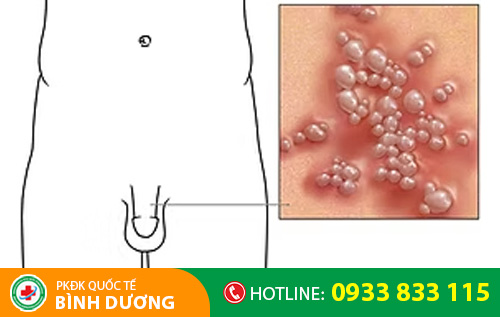 Dương vật nổi mẩn đỏ là dấu hiệu nhiều bệnh nguy hiểm