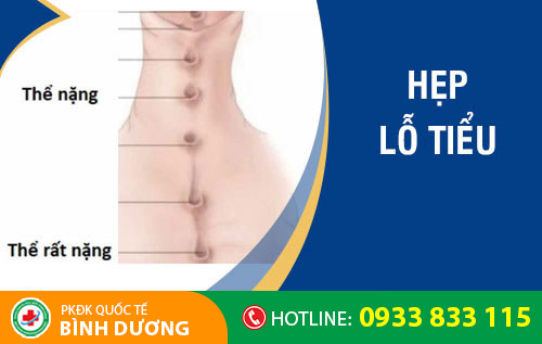 hẹp lỗ tiểu