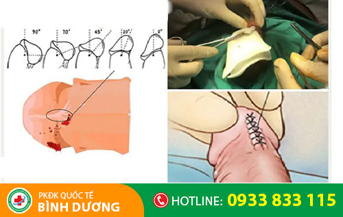 Hình ảnh hỗ trợ điều trị rách dương vật