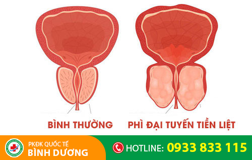 Hình ảnh phì đại tuyến tiền liệt