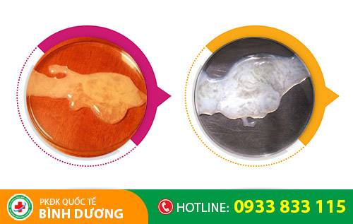 Hình ảnh tinh trùng đặc, tinh trùng vón cục