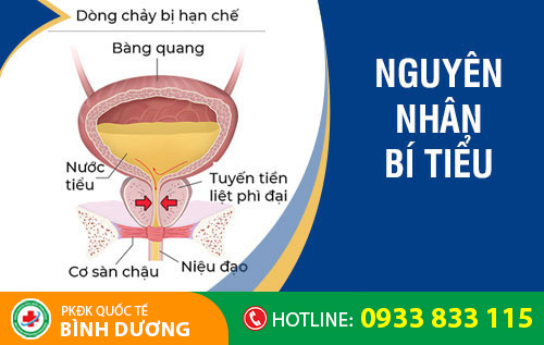 Nguyên nhân gây bí tiểu