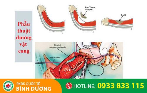 Biến chứng cong dương vật do kỹ thuật khâu không đúng cách