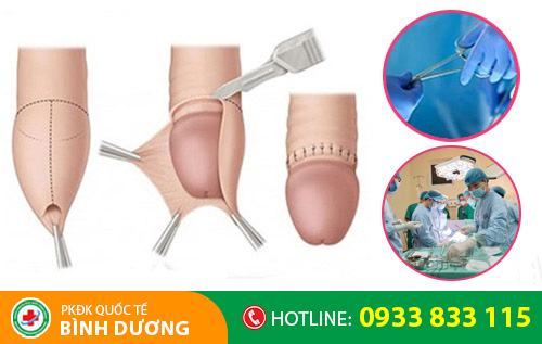 Phương pháp hỗ trợ điều trị đau buốt quy đầu hiệu quả