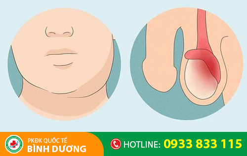Sưng tinh hoàn bên trái là dấu hiệu nhiều bệnh nguy hiểm