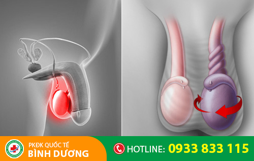 Nhiều tác hại nguy hiểm khi bị sưng tinh hoàn trái