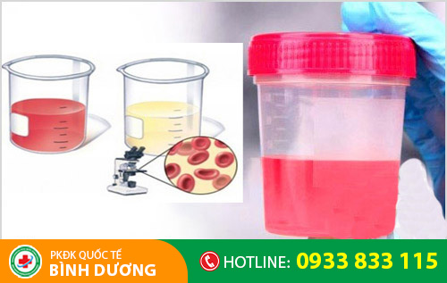 Tiểu ra máu đại thể và vi thể ở nam giới