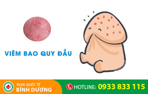 Đau buốt quy đầu do viêm bao quy đầu
