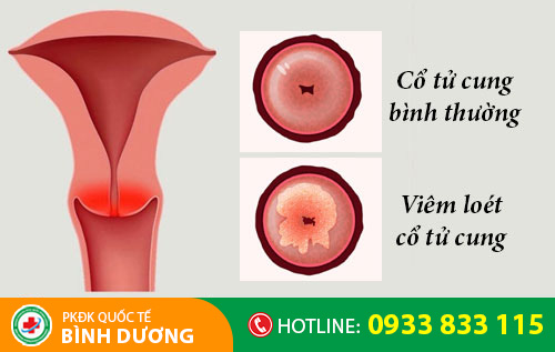 Viêm loét cổ tử cung