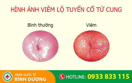 viêm lộ tuyến cổ tử cung