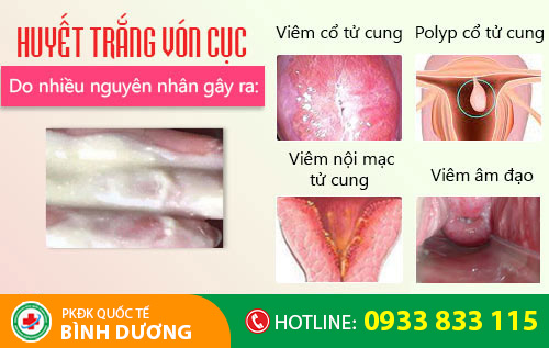 Nguyên nhân huyết trắng vón cục