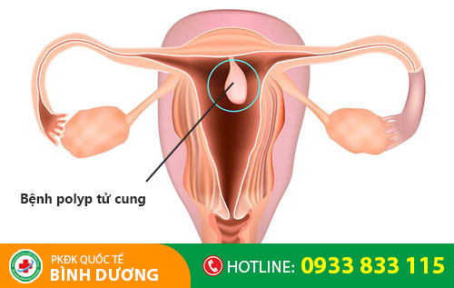 Polyp tử cung