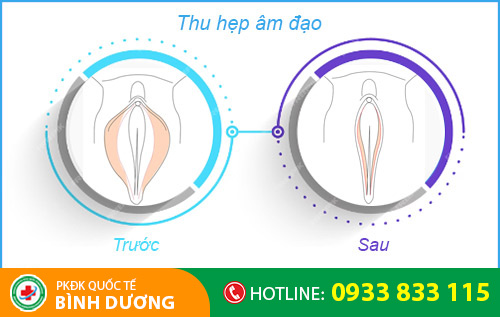 Thu hẹp âm đạo