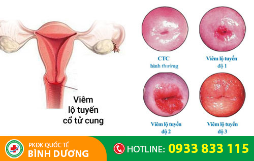 Viêm lộ tuyến cổ tử cung