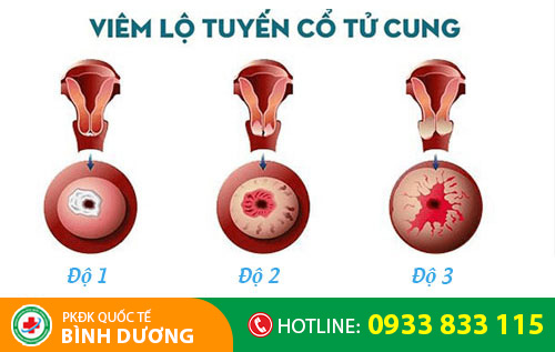 Viêm lộ tuyến cổ tử cung