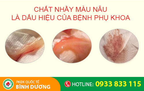Chấy nhầy màu nâu là dấu hiệu của bệnh phụ khoa