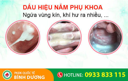 Dấu hiệu nấm phụ khoa