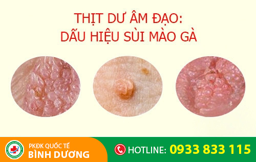 dấu hiệu sùi mào gà