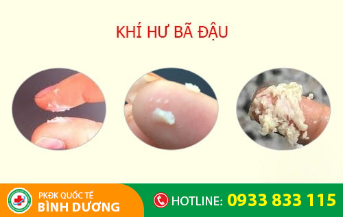 Hiện tượng khí hư bả đậu