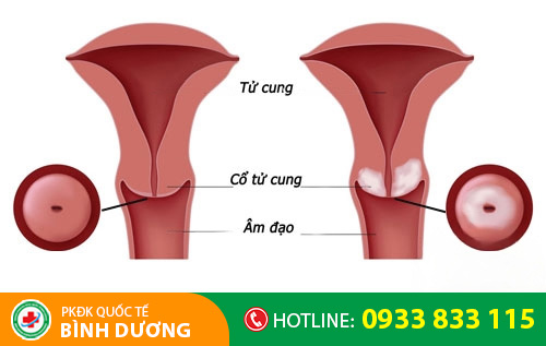 Các bệnh tử cung, cổ tử cung khiến kinh nguyệt có mùi hôi tanh