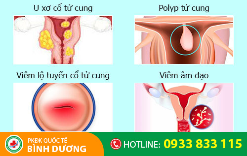 Nguyên nhân khí hư có màu trắng
