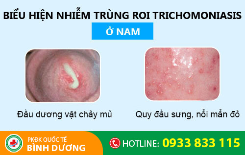 Nhiễm trichomonas ở nam giới