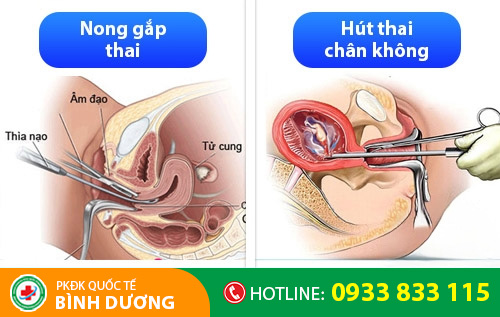Hút thai chân không, nong gắp thai
