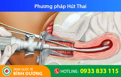 Bỏ thai 8 tuần bằng phương pháp hút thai