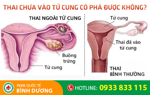 Thai chưa vào tử cung có phá được không