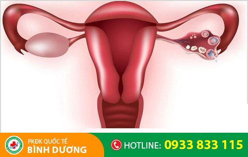 Hình ảnh bệnh viêm phần phụ
