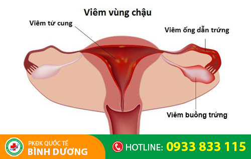 Viêm vùng chậu