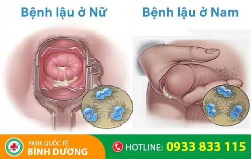 benh lau la gi