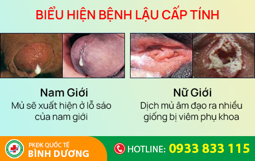 bieu hien benh lau cap tinh
