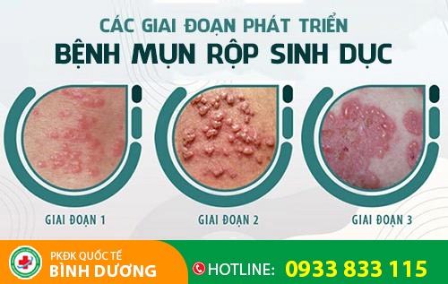 Biểu hiện mụn rộp sinh dục ở nữ