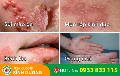cac benh lay qua duong tinh duc