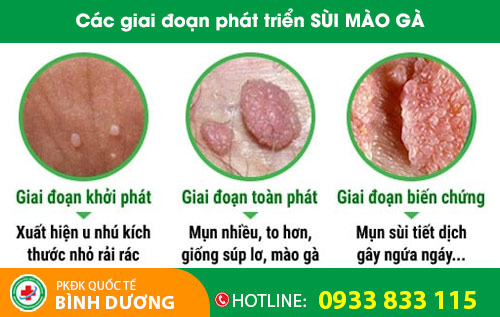 Các giai đoạn phát triển sùi mào gà