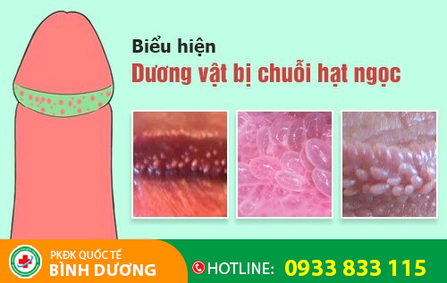 Chuỗi hạt ngọc dương vật