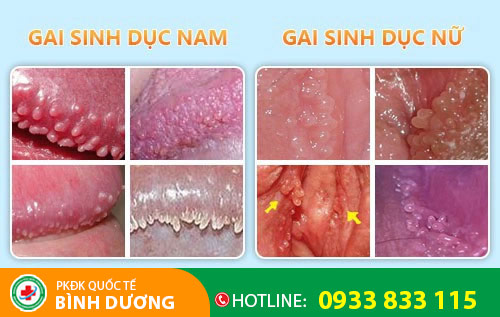Hình ảnh gai sinh dục
