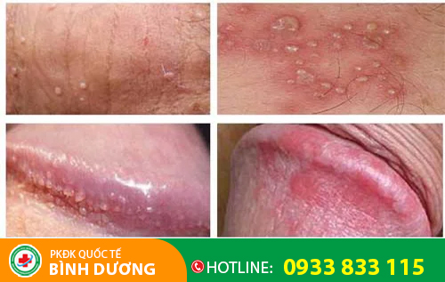 Mụn cóc sinh dục ở nam