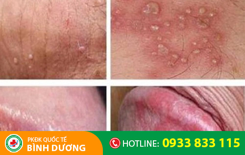 Triệu chứng mụn rộp sinh dục nam