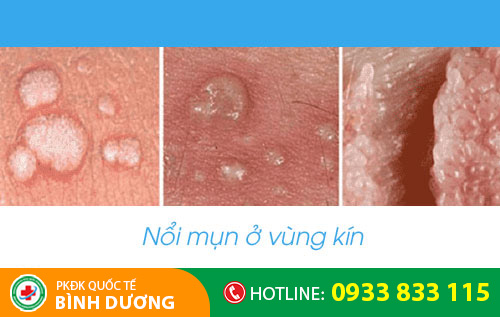 Hình ảnh nổi mụn ở vùng kín