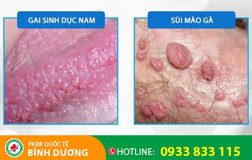 Biểu hiện gai sinh dục và sùi mào gà
