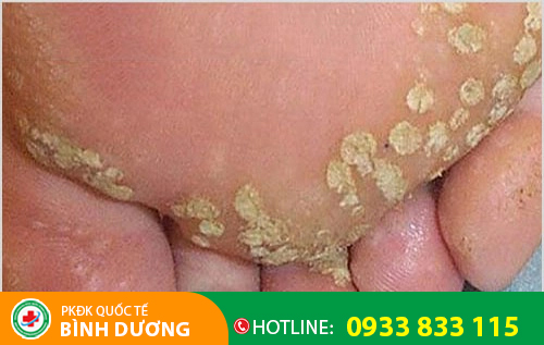 Các nốt u nhú mào gà ở chân