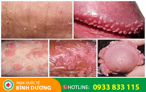 Sùi mào gà ở dương vật