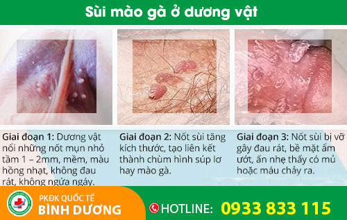 Sùi mào gà ở dương vật